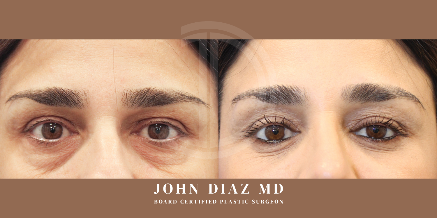 Dr John Diaz Before and After | Blepharoplasty