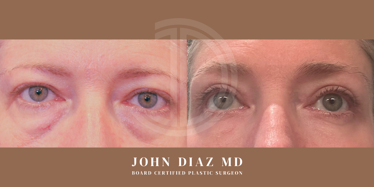 Dr John Diaz Before and After | Blepharoplasty