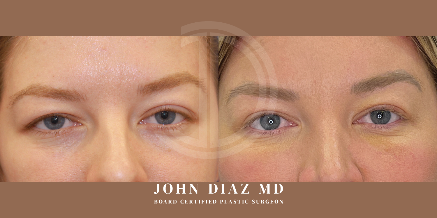 Dr John Diaz Before and After | Blepharoplasty