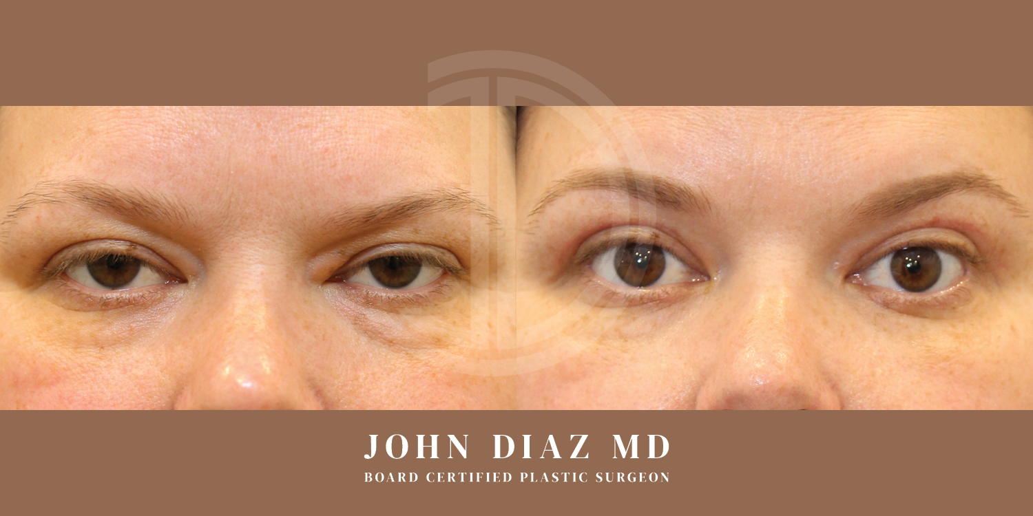 Dr John Diaz Before and After | Blepharoplasty
