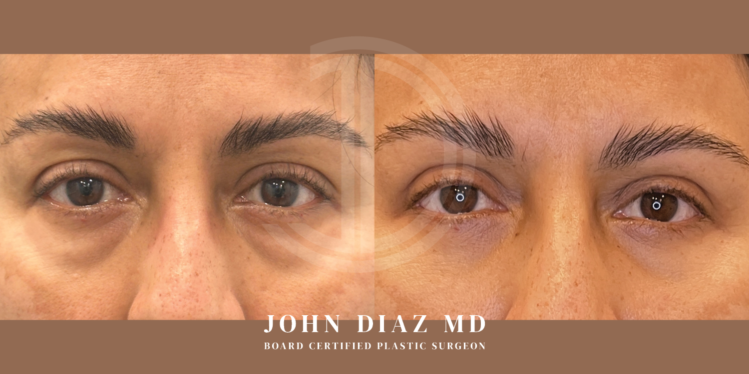 Dr John Diaz Before and After | Blepharoplasty
