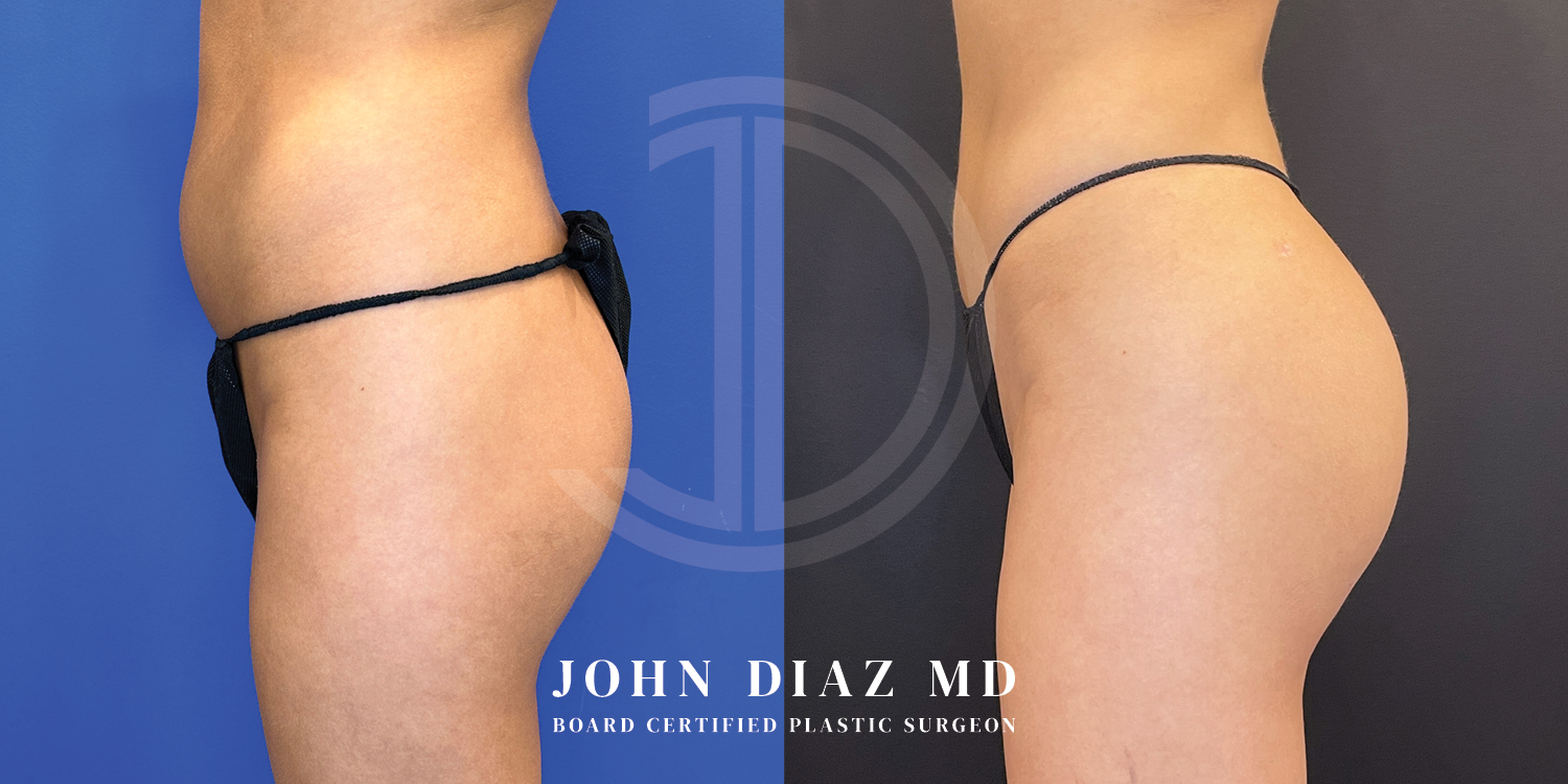 Dr John Diaz Before and After | Brazilian Butt Lift