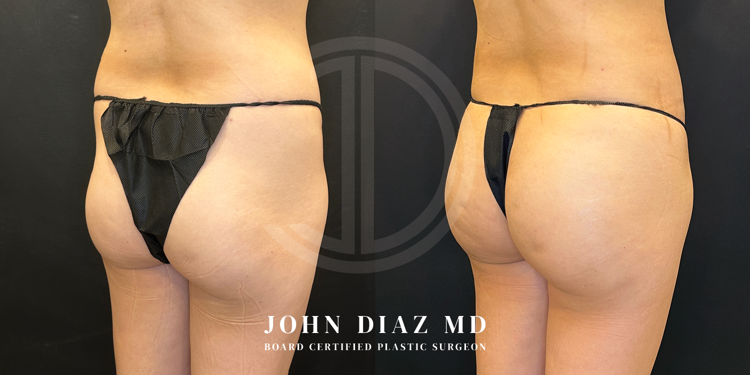Dr John Diaz Before and After | Brazilian Butt Lift
