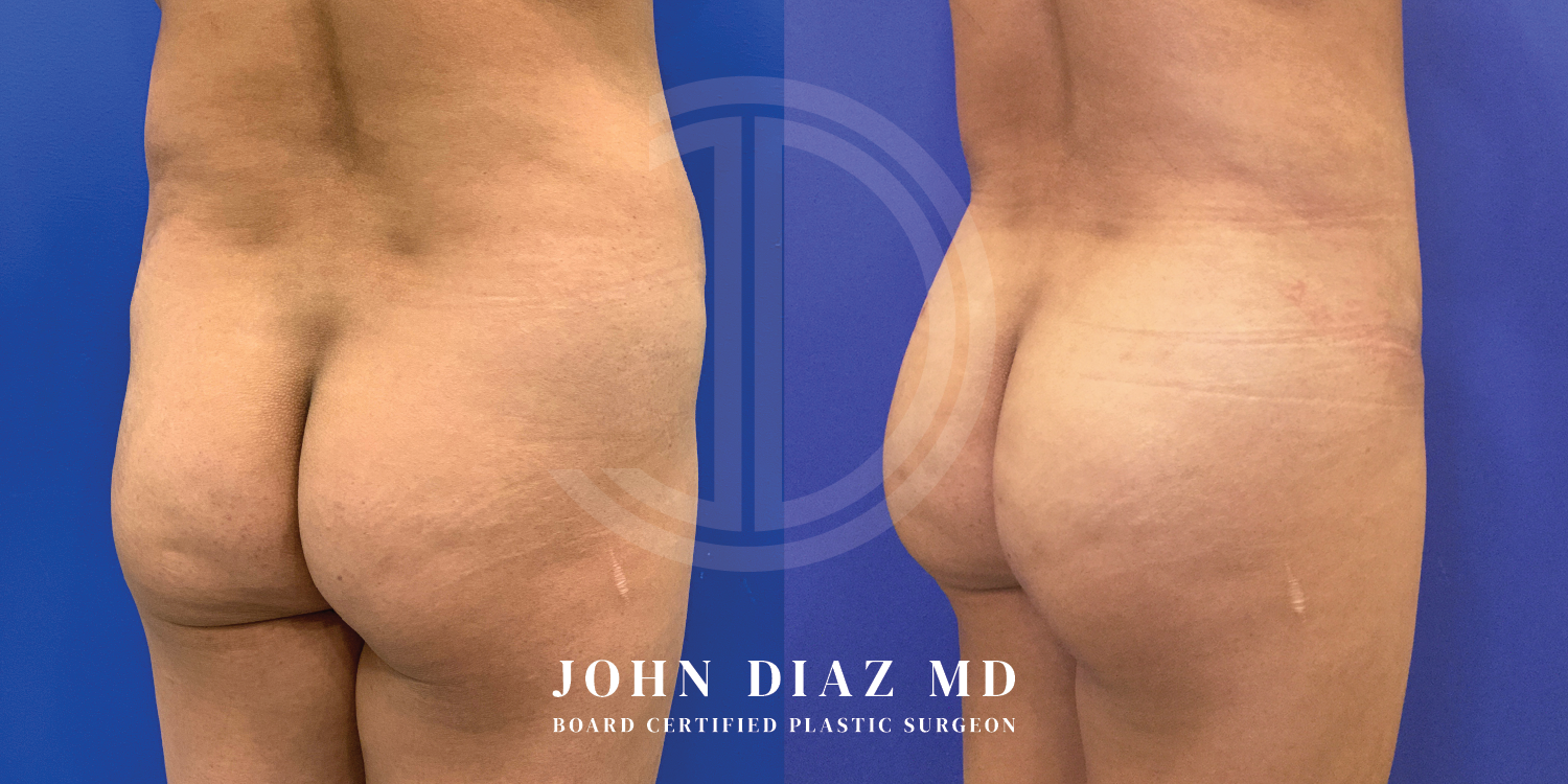Dr John Diaz Before and After | Brazilian Butt Lift