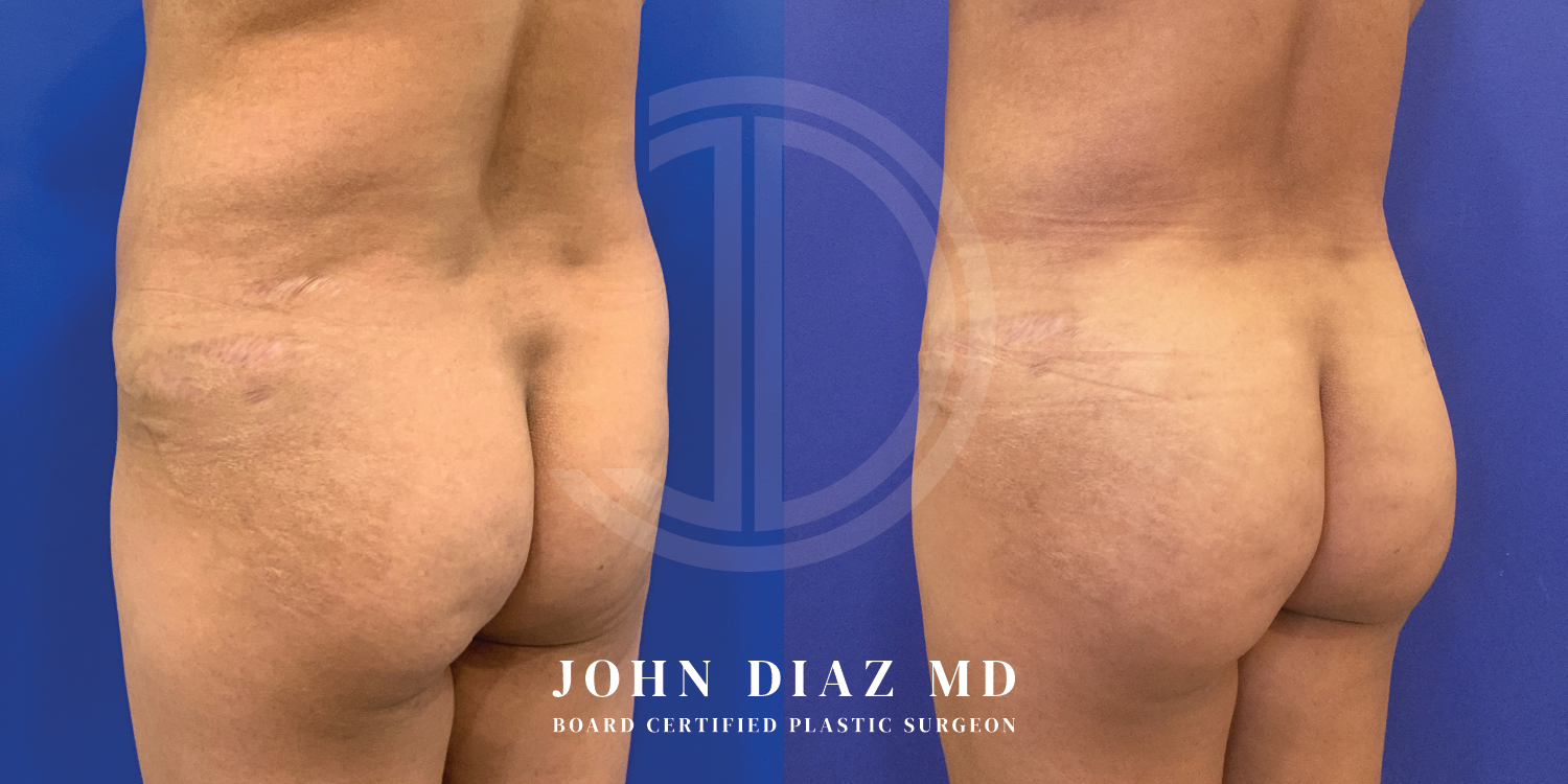 Dr John Diaz Before and After | Brazilian Butt Lift