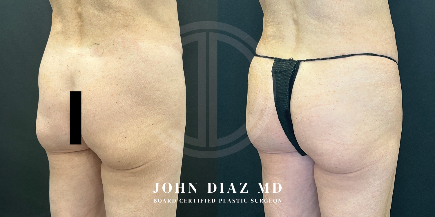 Dr John Diaz Before and After | Brazilian Butt Lift