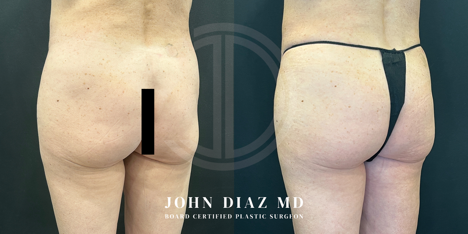 Dr John Diaz Before and After | Brazilian Butt Lift