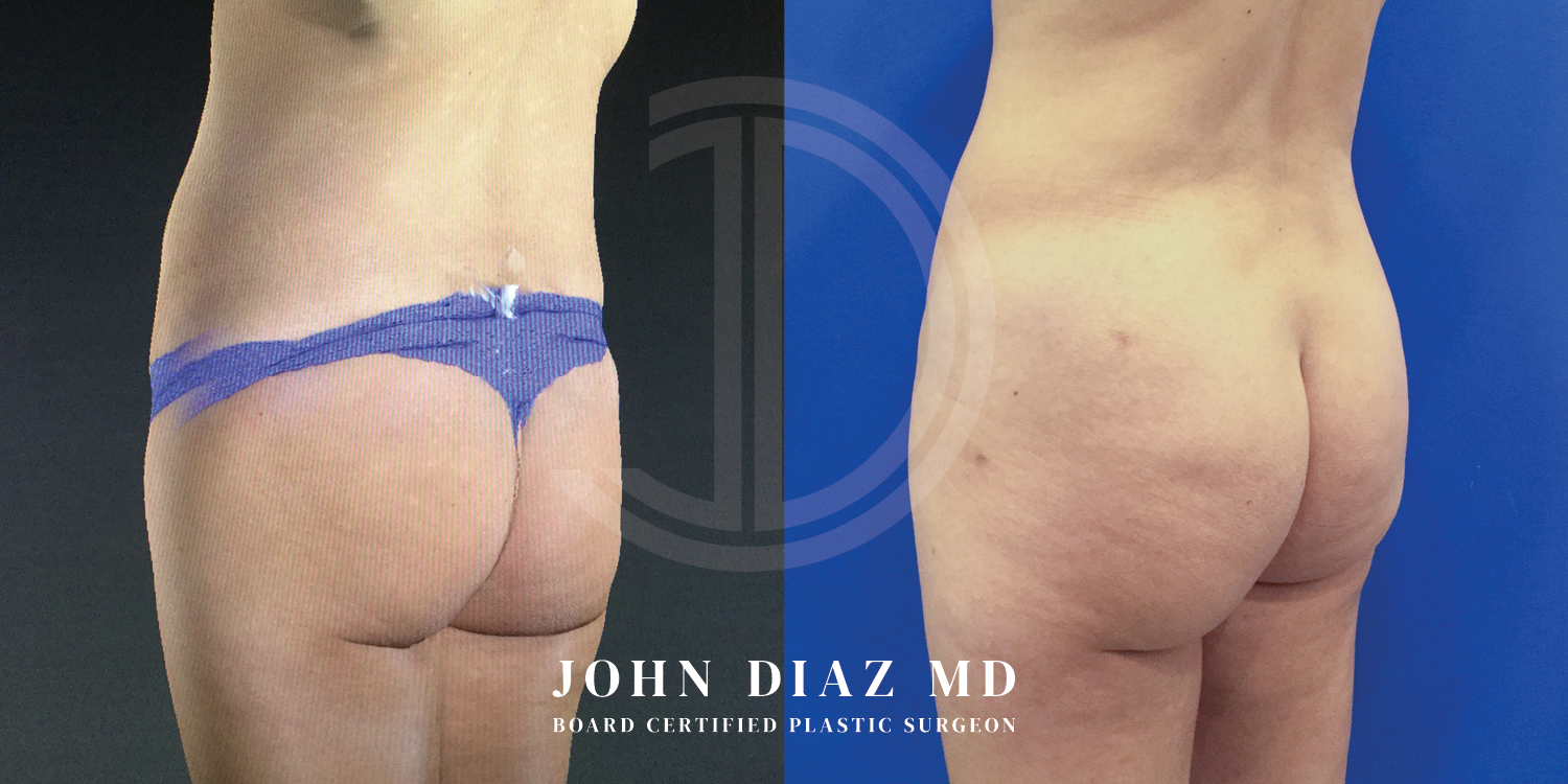 Dr John Diaz Before and After | Brazilian Butt Lift