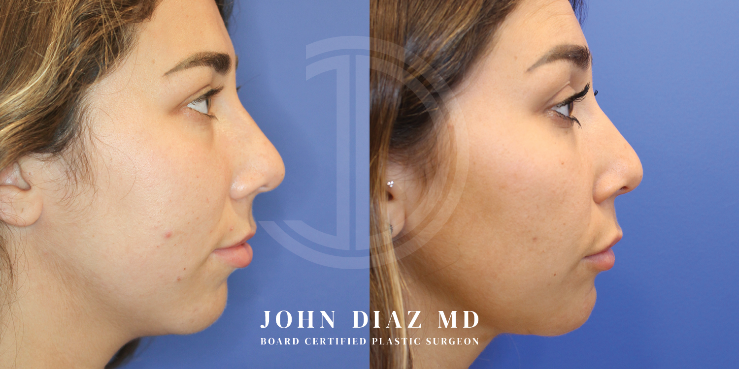Dr John Diaz Before and After | Buccal Lipectomy, Buccal Fat Removal