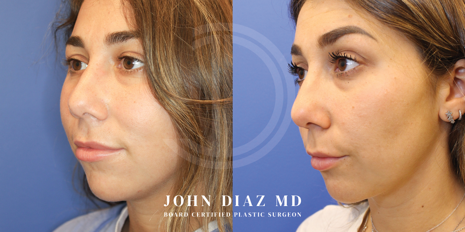Dr John Diaz Before and After | Buccal Lipectomy, Buccal Fat Removal