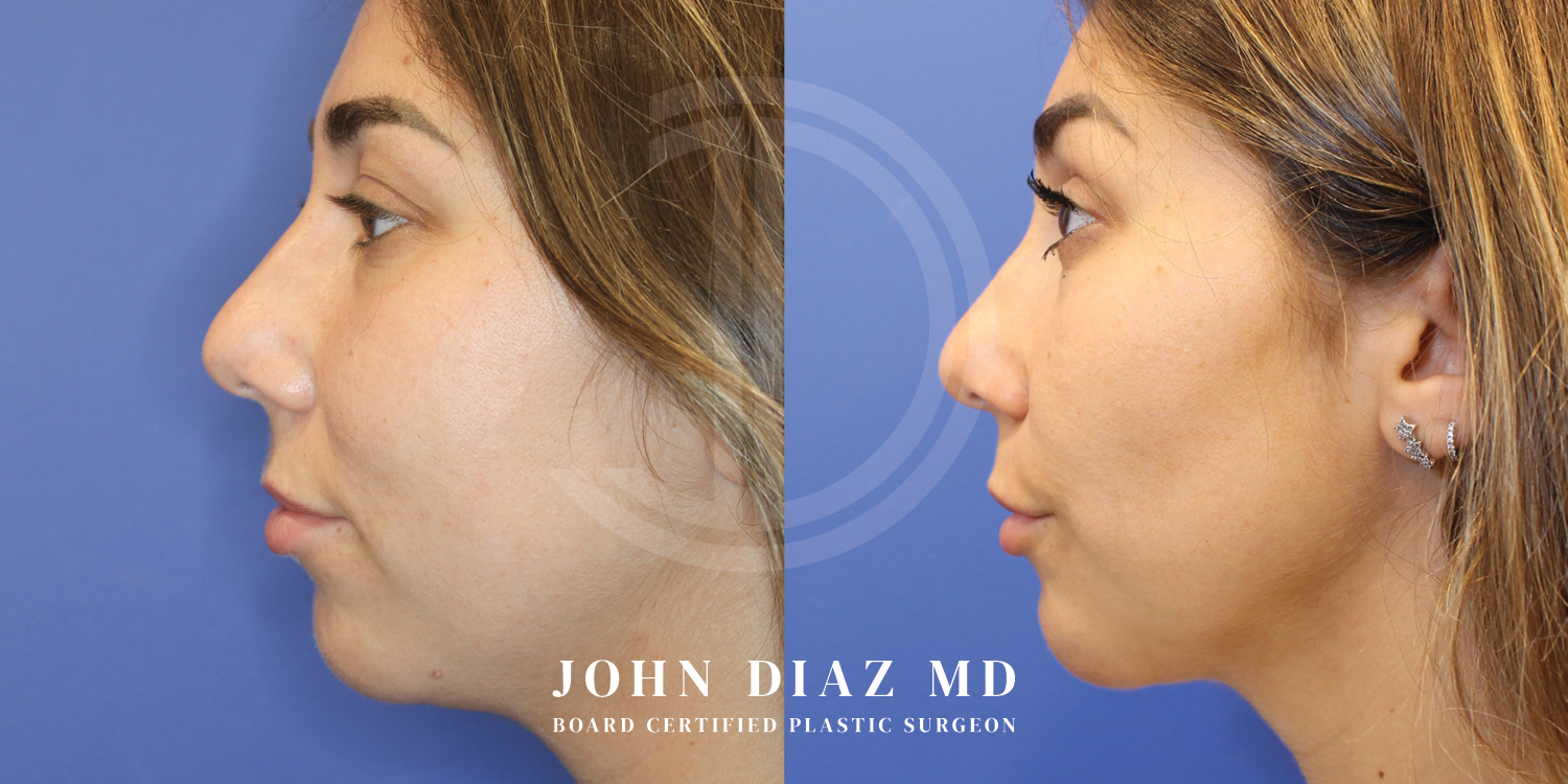 Dr John Diaz Before and After | Buccal Lipectomy, Buccal Fat Removal
