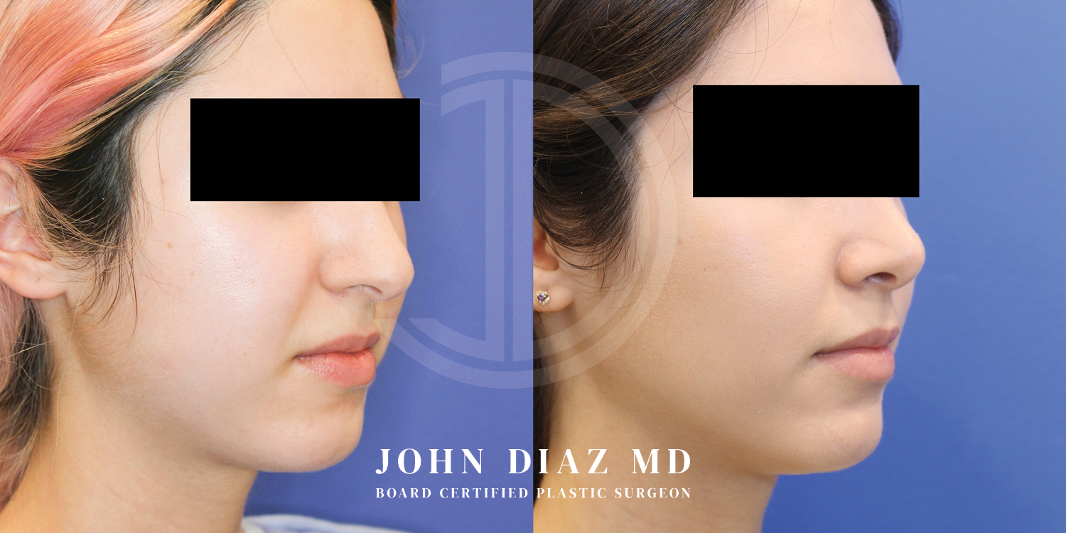 Dr John Diaz Before and After | Buccal Lipectomy, Buccal Fat Removal