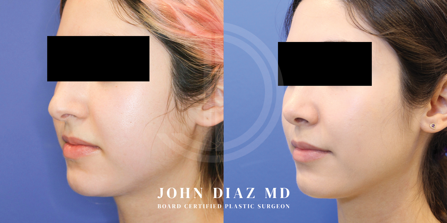 Dr John Diaz Before and After | Buccal Lipectomy, Buccal Fat Removal
