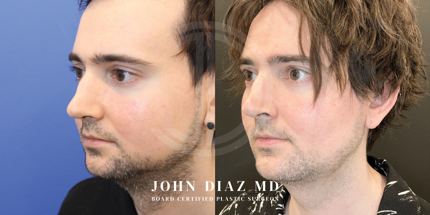 Dr John Diaz Before and After | Buccal Lipectomy, Buccal Fat Removal