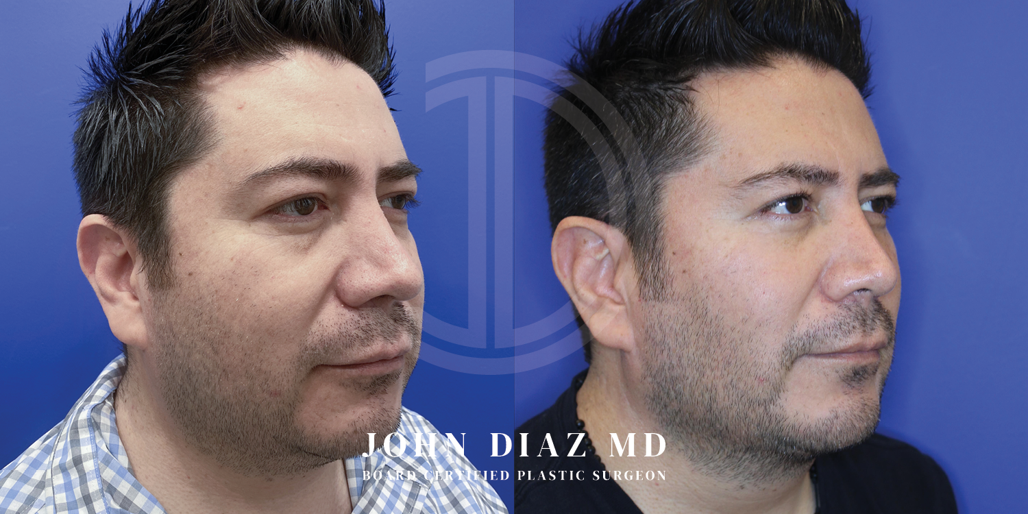 Dr John Diaz Before and After | Buccal Lipectomy, Buccal Fat Removal