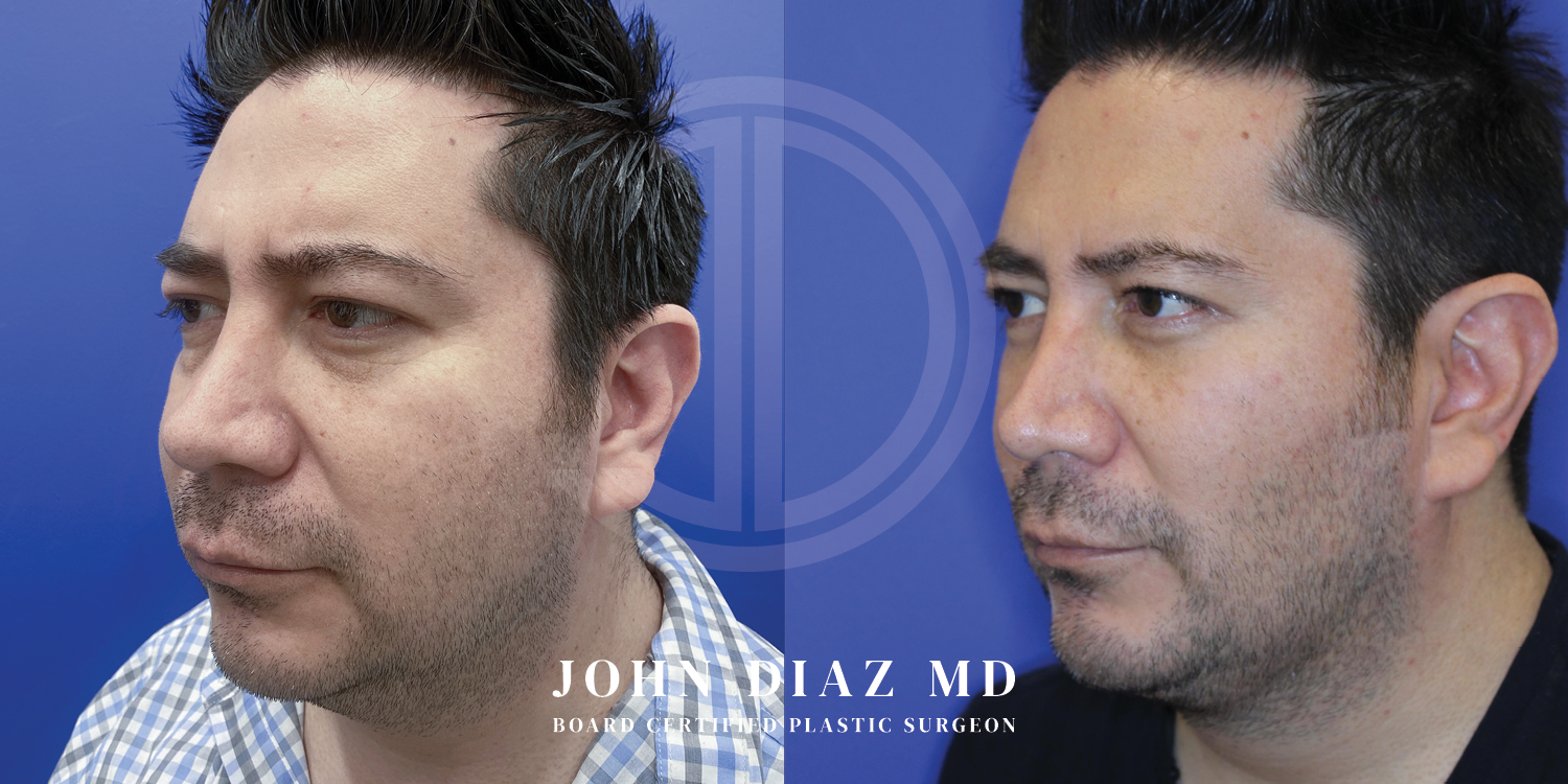 Dr John Diaz Before and After | Buccal Lipectomy, Buccal Fat Removal