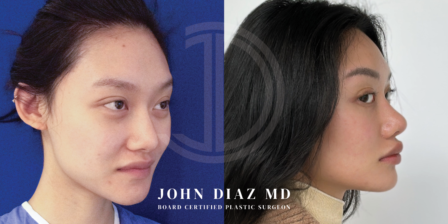 Dr John Diaz Before and After | Buccal Lipectomy, Buccal Fat Removal