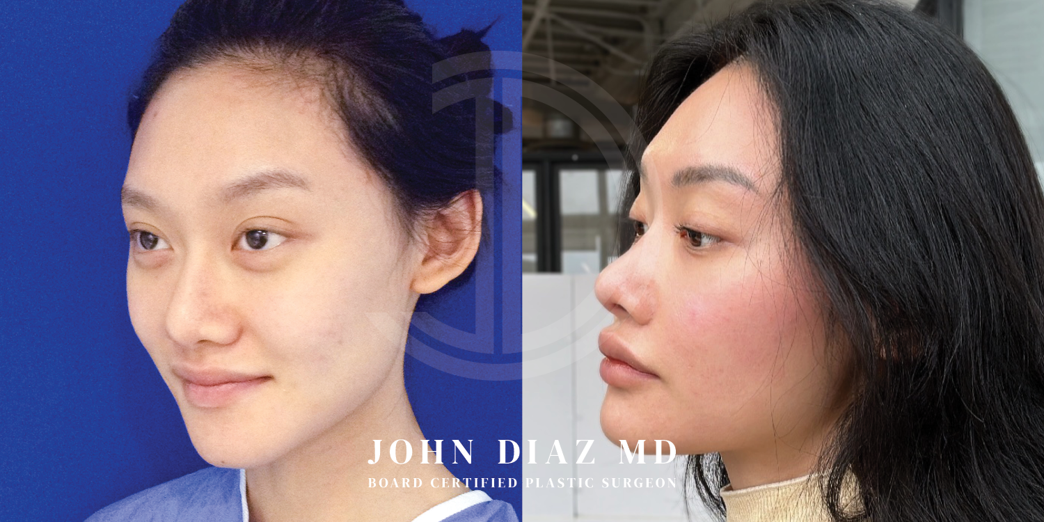 Dr John Diaz Before and After | Buccal Lipectomy, Buccal Fat Removal