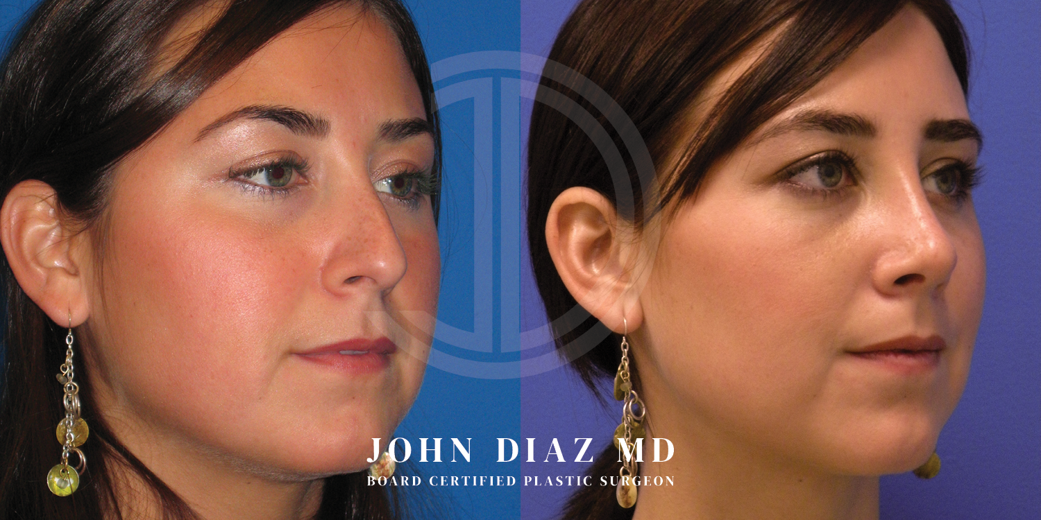 Dr John Diaz Before and After | Buccal Lipectomy, Buccal Fat Removal