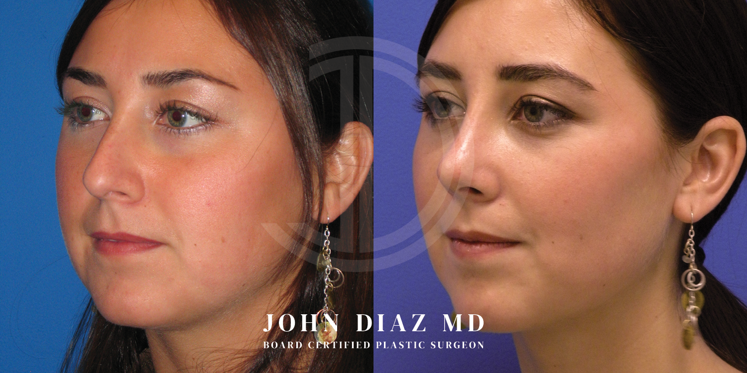 Dr John Diaz Before and After | Buccal Lipectomy, Buccal Fat Removal
