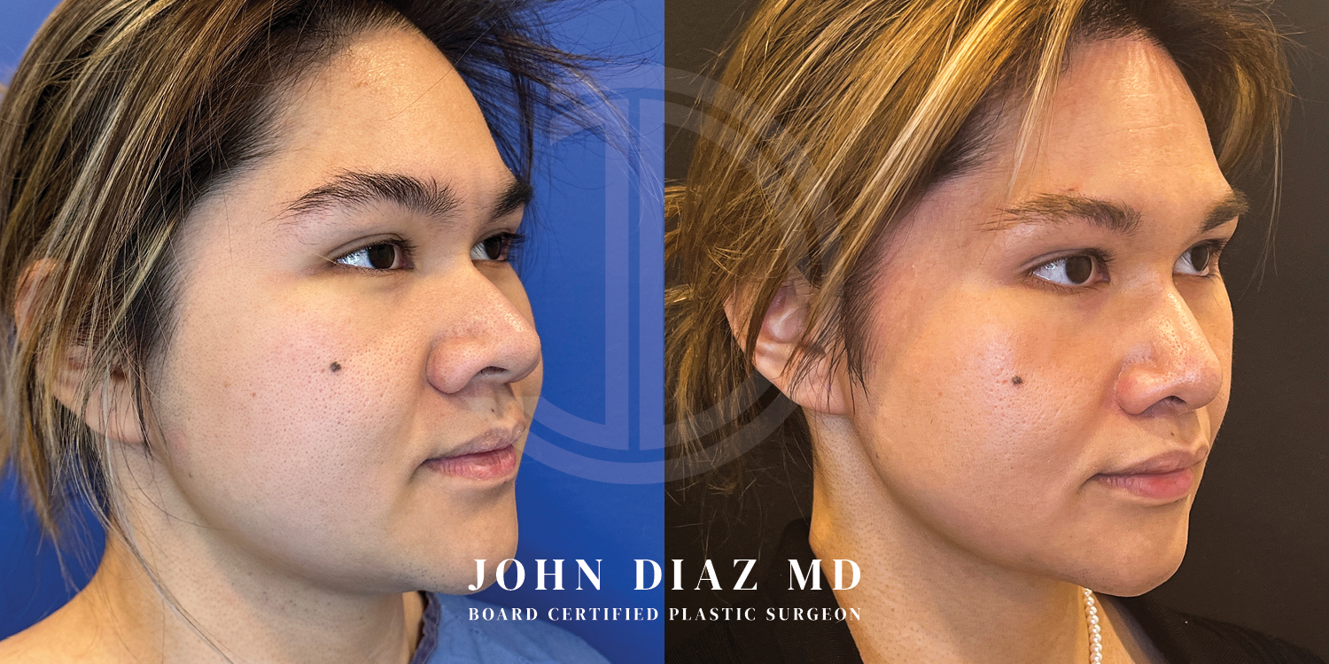 Dr John Diaz Before and After | Buccal Lipectomy, Buccal Fat Removal