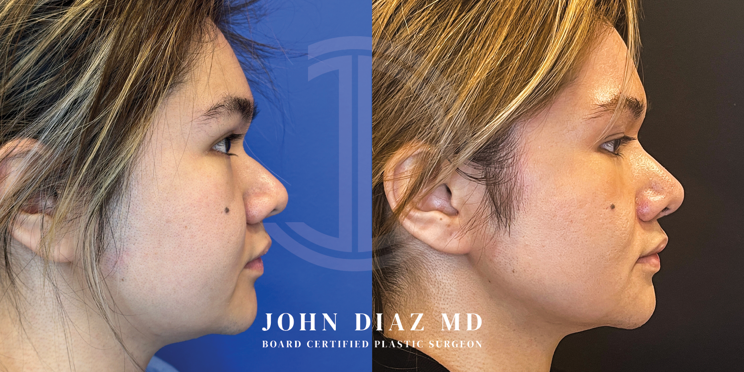 Dr John Diaz Before and After | Buccal Lipectomy, Buccal Fat Removal