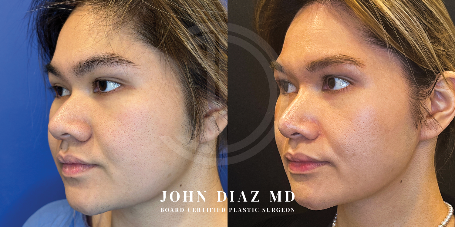 Dr John Diaz Before and After | Buccal Lipectomy, Buccal Fat Removal
