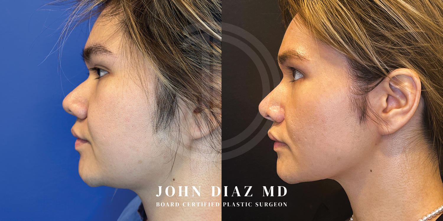 Dr John Diaz Before and After | Buccal Lipectomy, Buccal Fat Removal