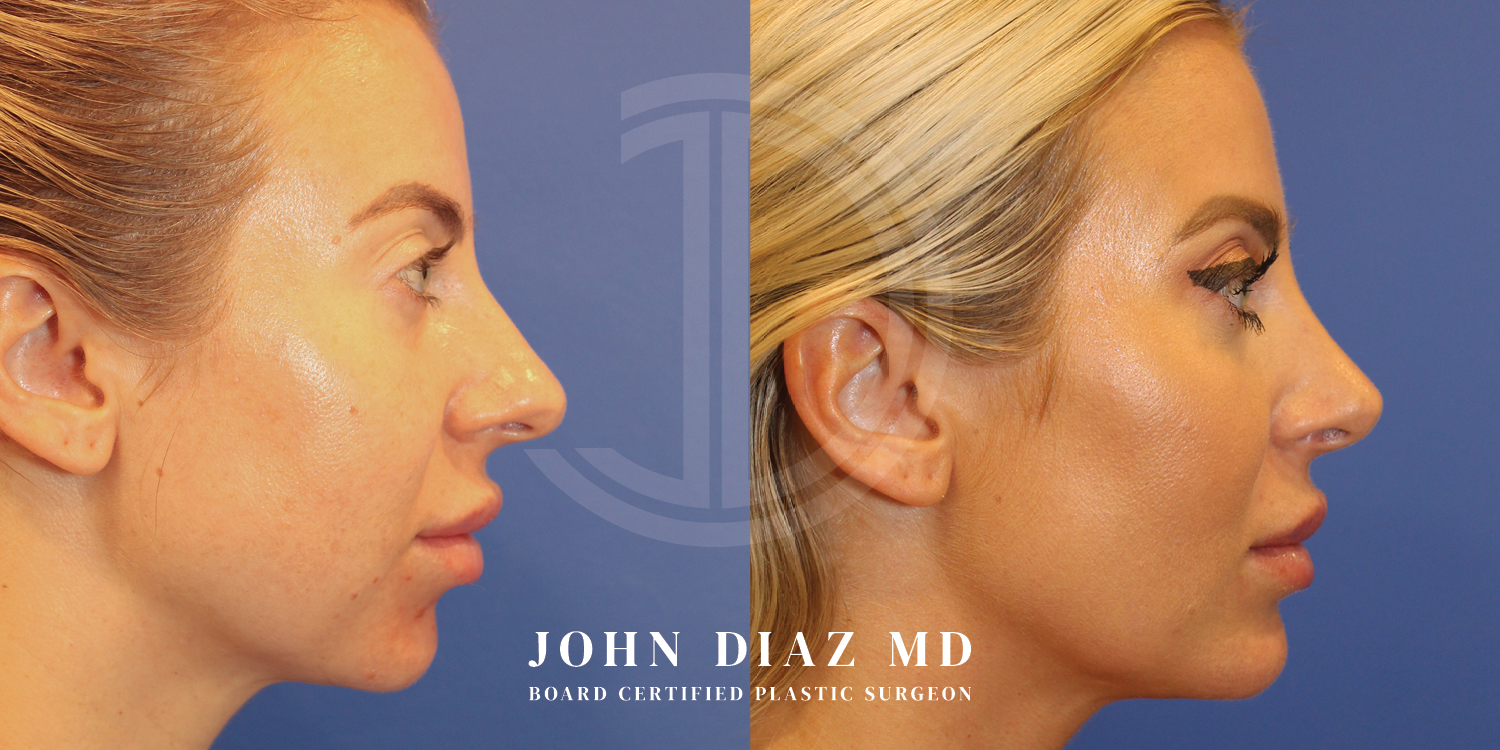 Dr John Diaz Buccal Lipectomy, Chin Augmentation, Rhinoplasty on female under 40