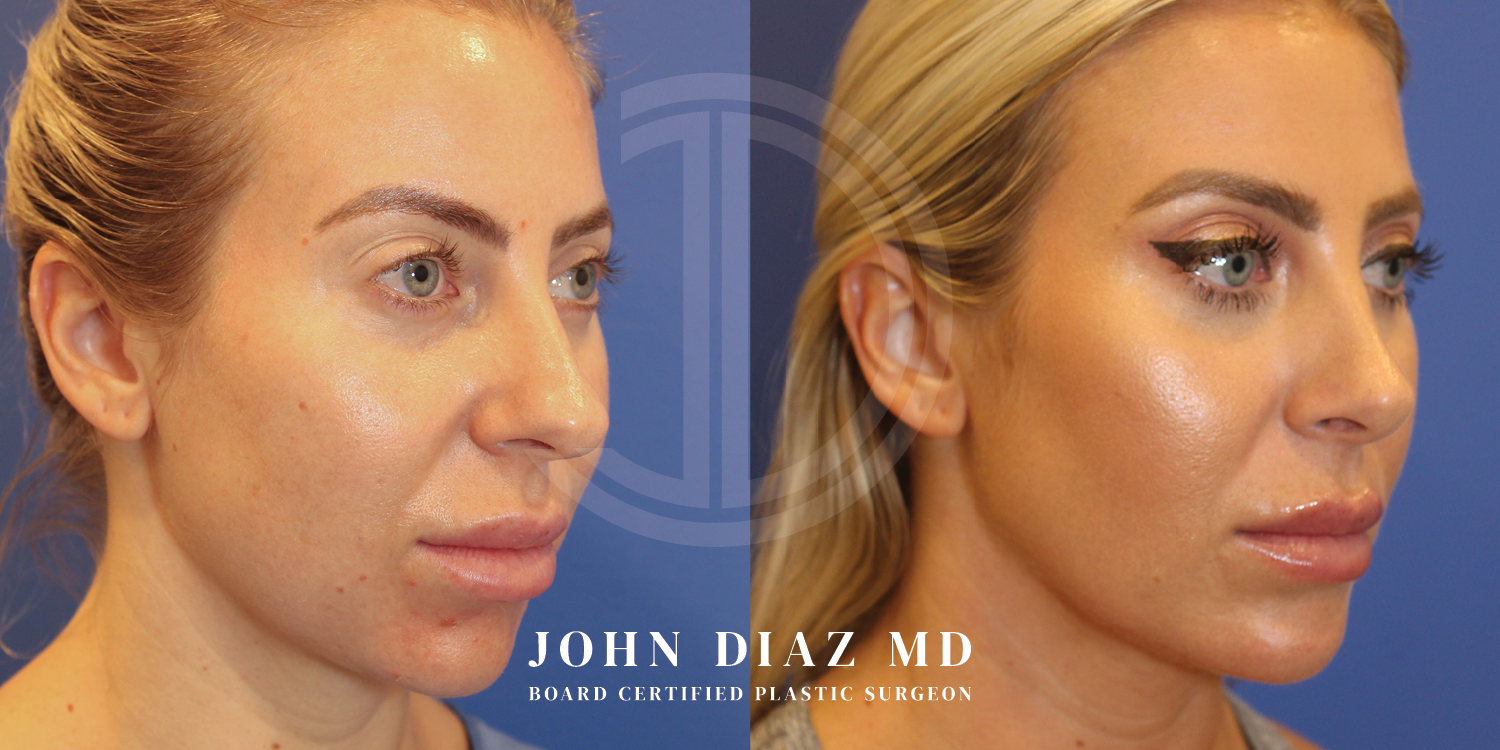 Dr John Diaz Buccal Lipectomy, Chin Augmentation, Rhinoplasty on female under 40