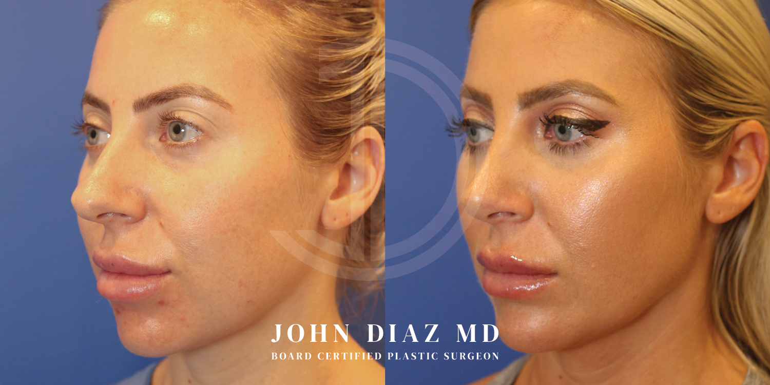 Dr John Diaz Buccal Lipectomy, Chin Augmentation, Rhinoplasty on female under 40