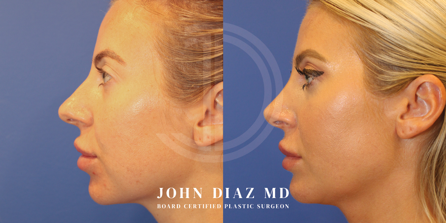 Dr John Diaz Buccal Lipectomy, Chin Augmentation, Rhinoplasty on female under 40