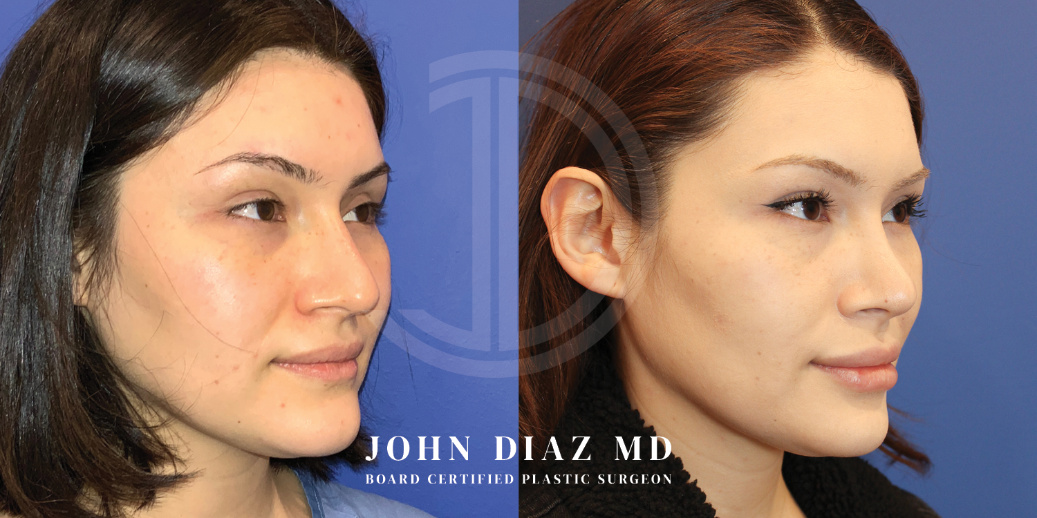 Dr John Diaz Before and After | Buccal Lipectomy, Buccal Fat Removal