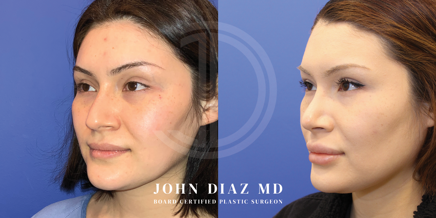 Dr John Diaz Before and After | Buccal Lipectomy, Buccal Fat Removal