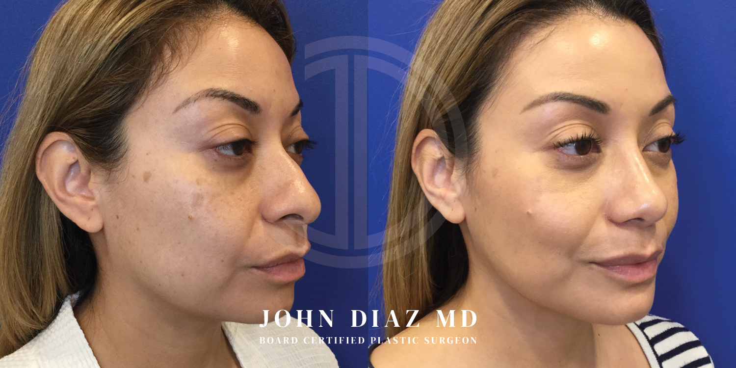 Dr John Diaz Before and After | Buccal Lipectomy, Buccal Fat Removal