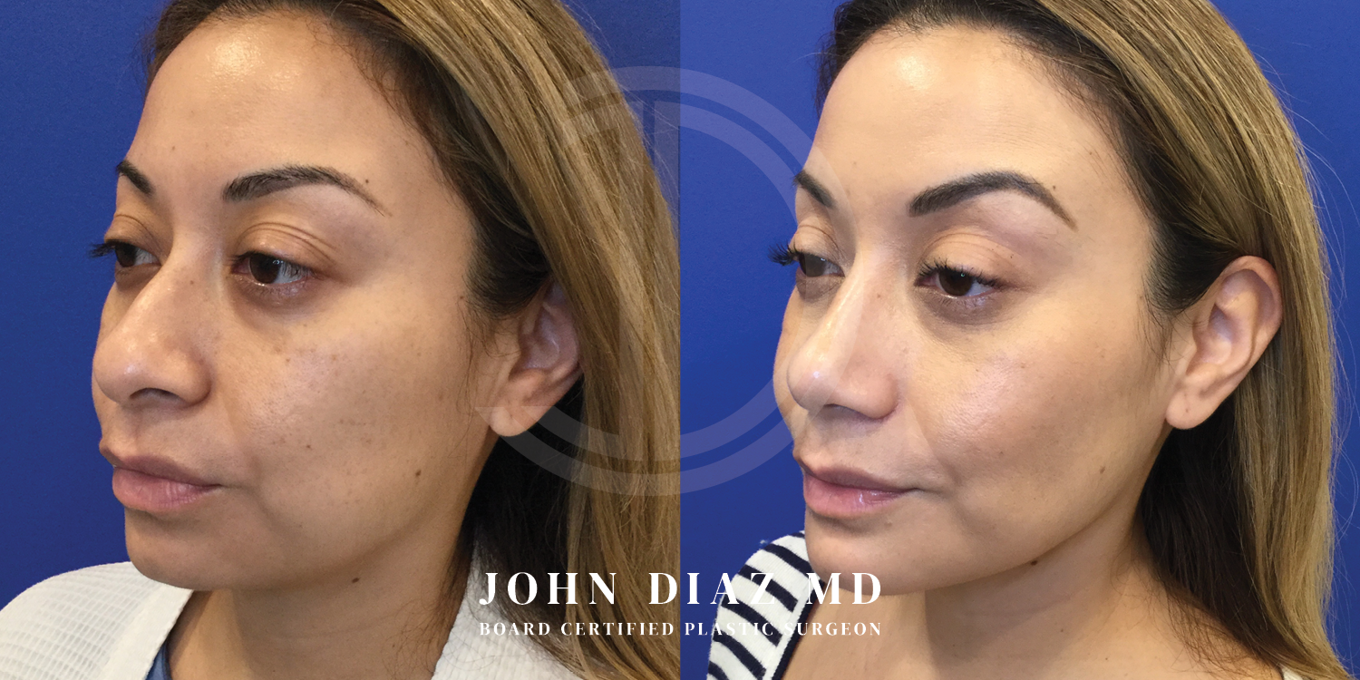Dr John Diaz Before and After | Buccal Lipectomy, Buccal Fat Removal