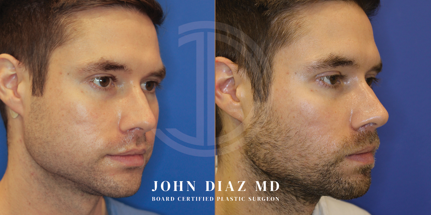 Dr John Diaz Before and After | Buccal Lipectomy, Buccal Fat Removal