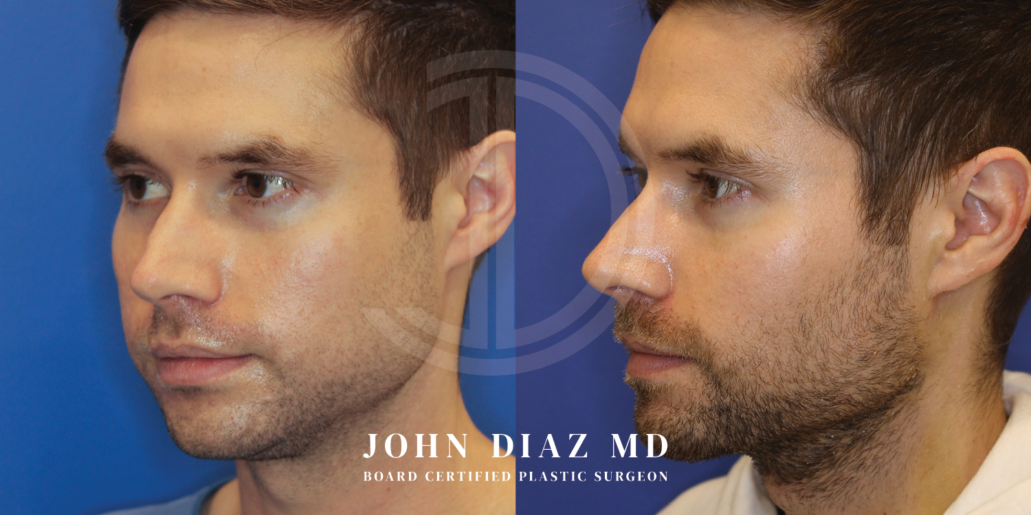 Dr John Diaz Before and After | Buccal Lipectomy, Buccal Fat Removal