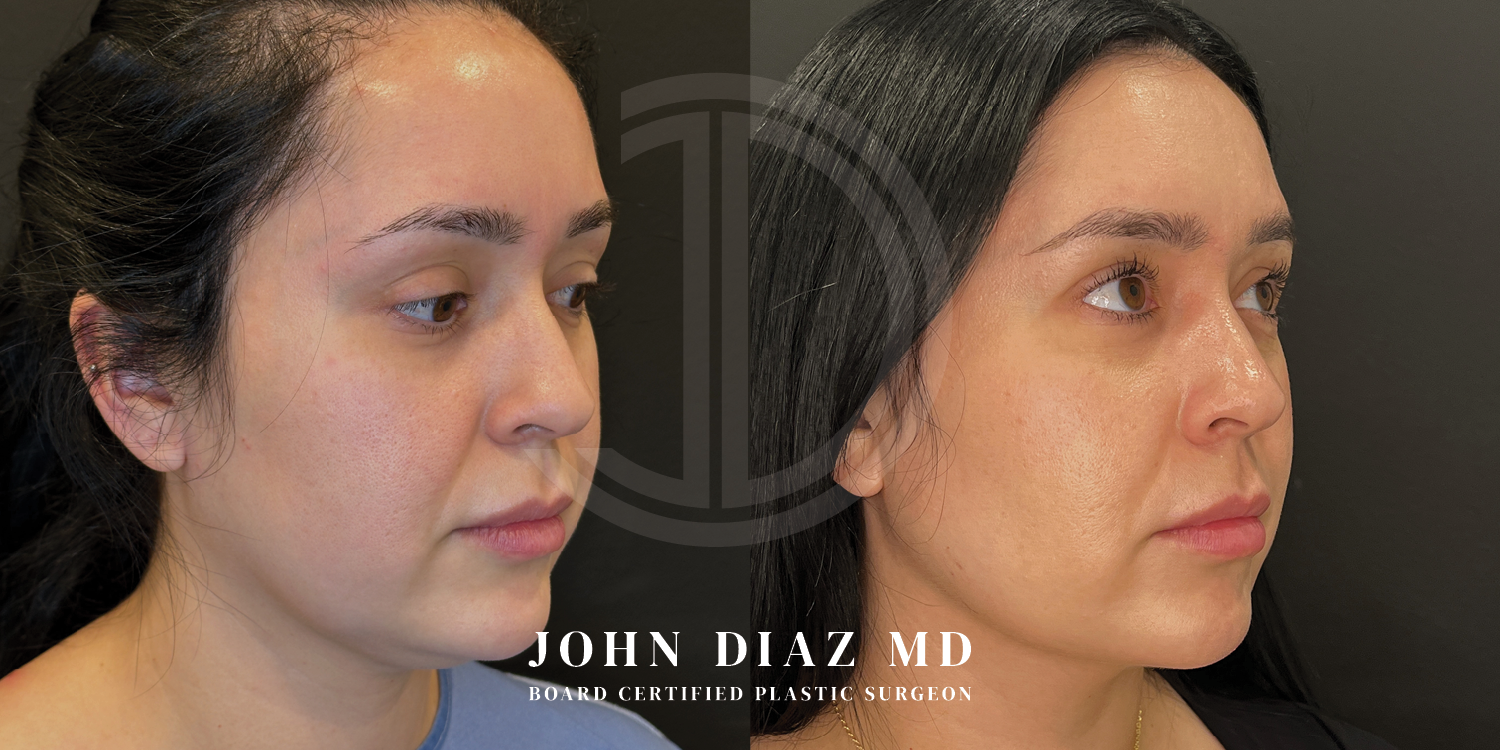 Dr John Diaz Before and After | Buccal Lipectomy, Buccal Fat Removal