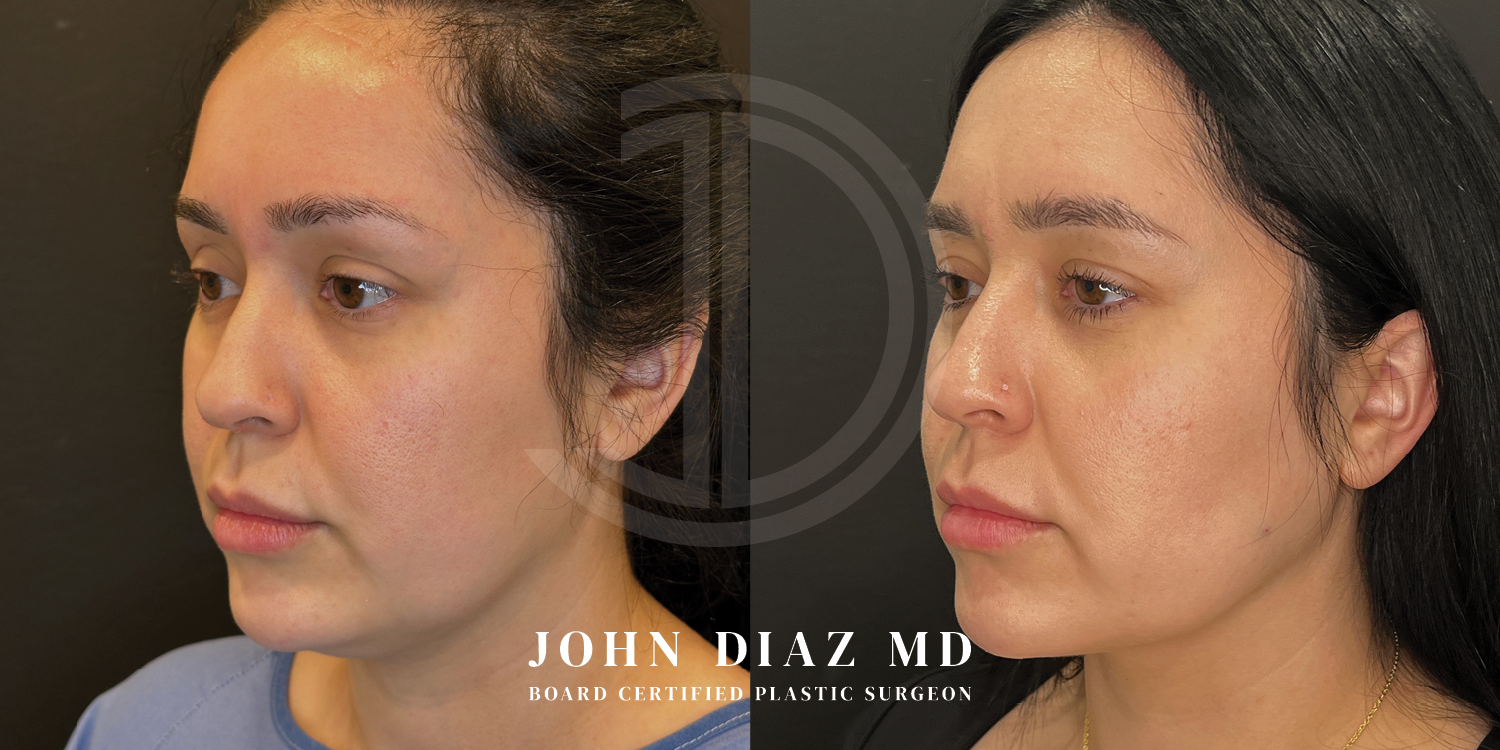 Dr John Diaz Before and After | Buccal Lipectomy, Buccal Fat Removal