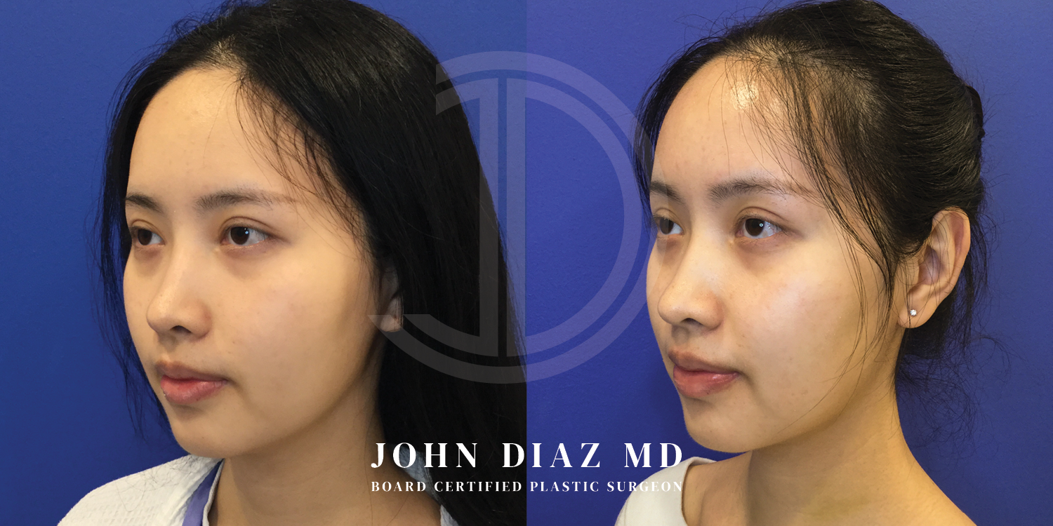 Dr John Diaz Before and After | Buccal Lipectomy, Buccal Fat Removal