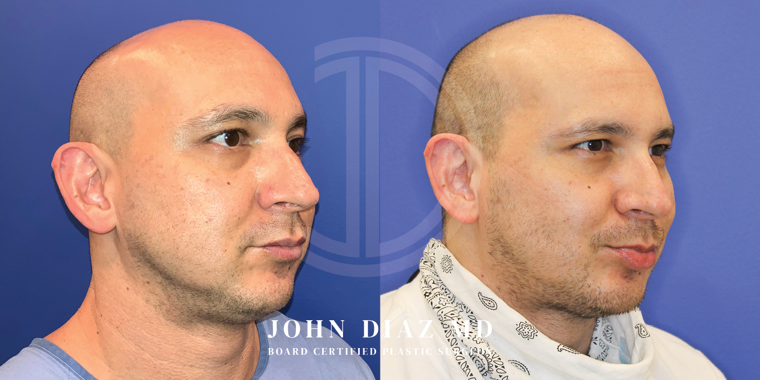 Dr John Diaz Before and After | Buccal Lipectomy, Buccal Fat Removal