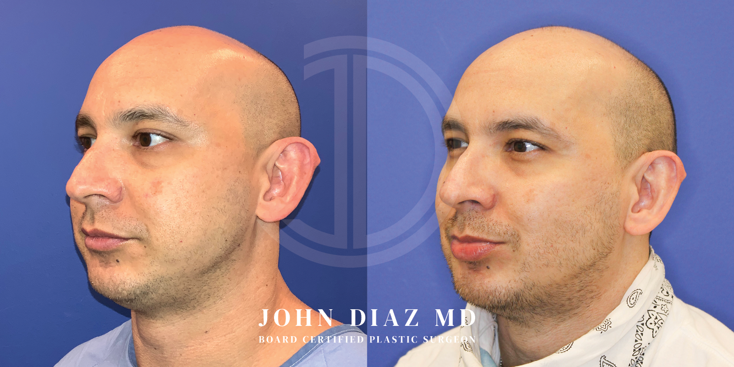Dr John Diaz Before and After | Buccal Lipectomy, Buccal Fat Removal
