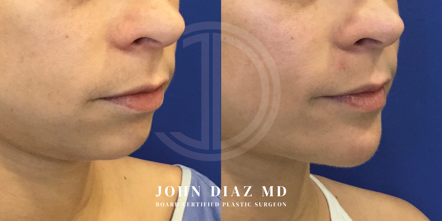 Dr John Diaz Chin Augmentation Before and After | Patient 10