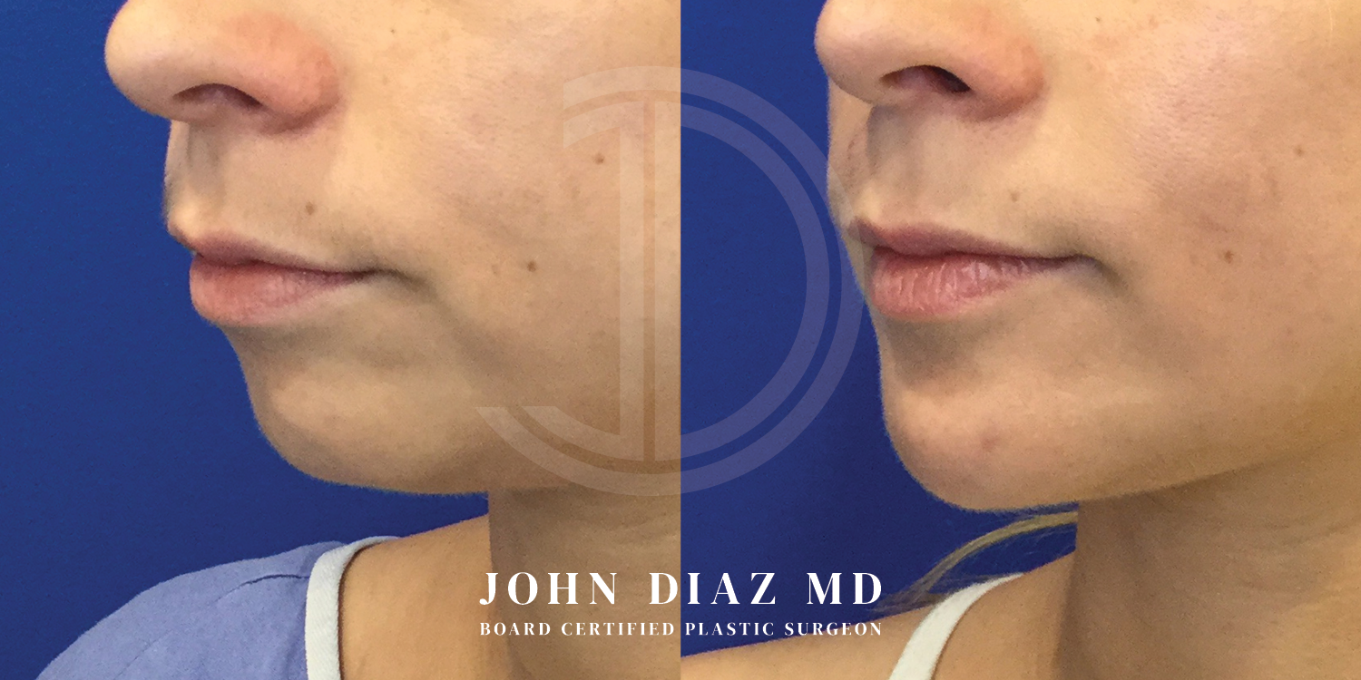 Dr John Diaz Chin Augmentation Before and After | Patient 10