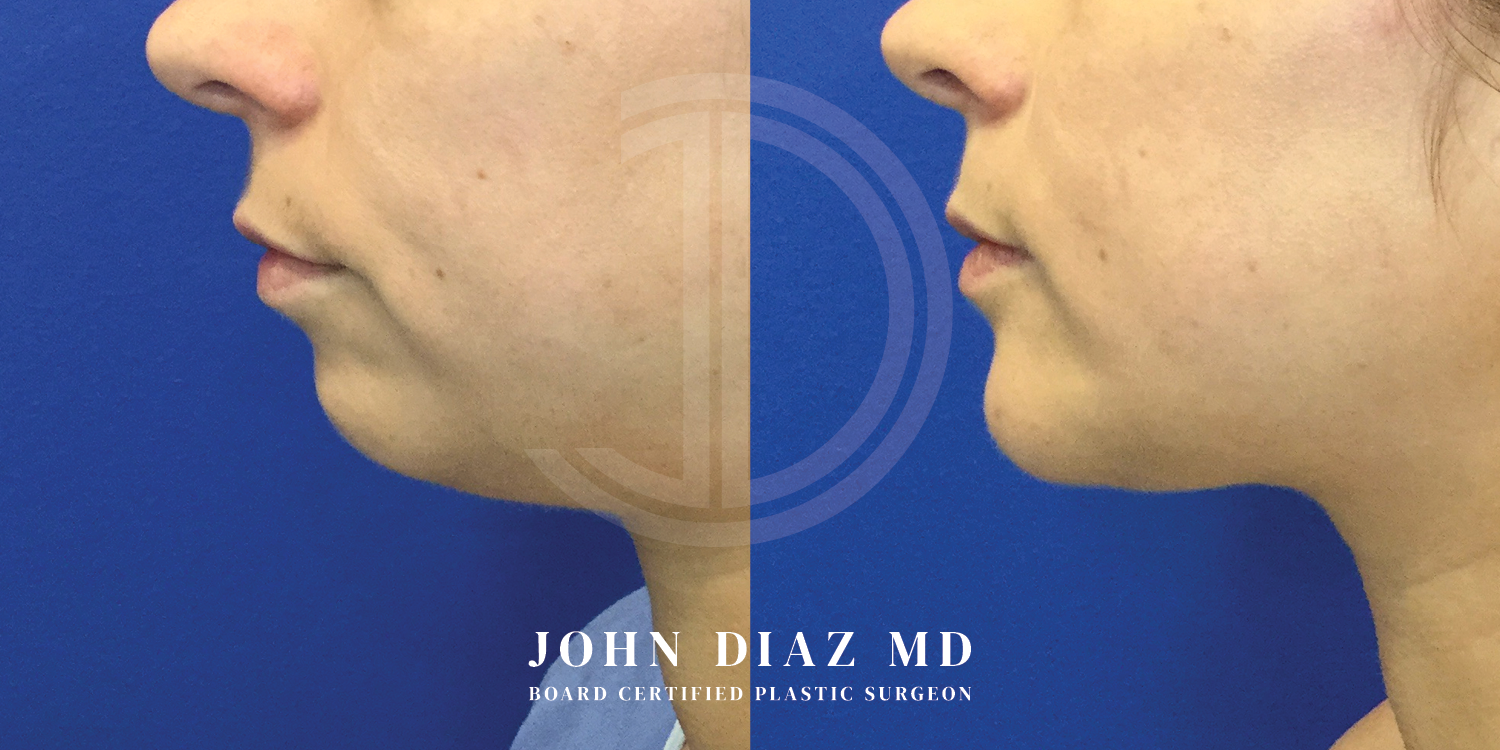 Dr John Diaz Chin Augmentation Before and After | Patient 10