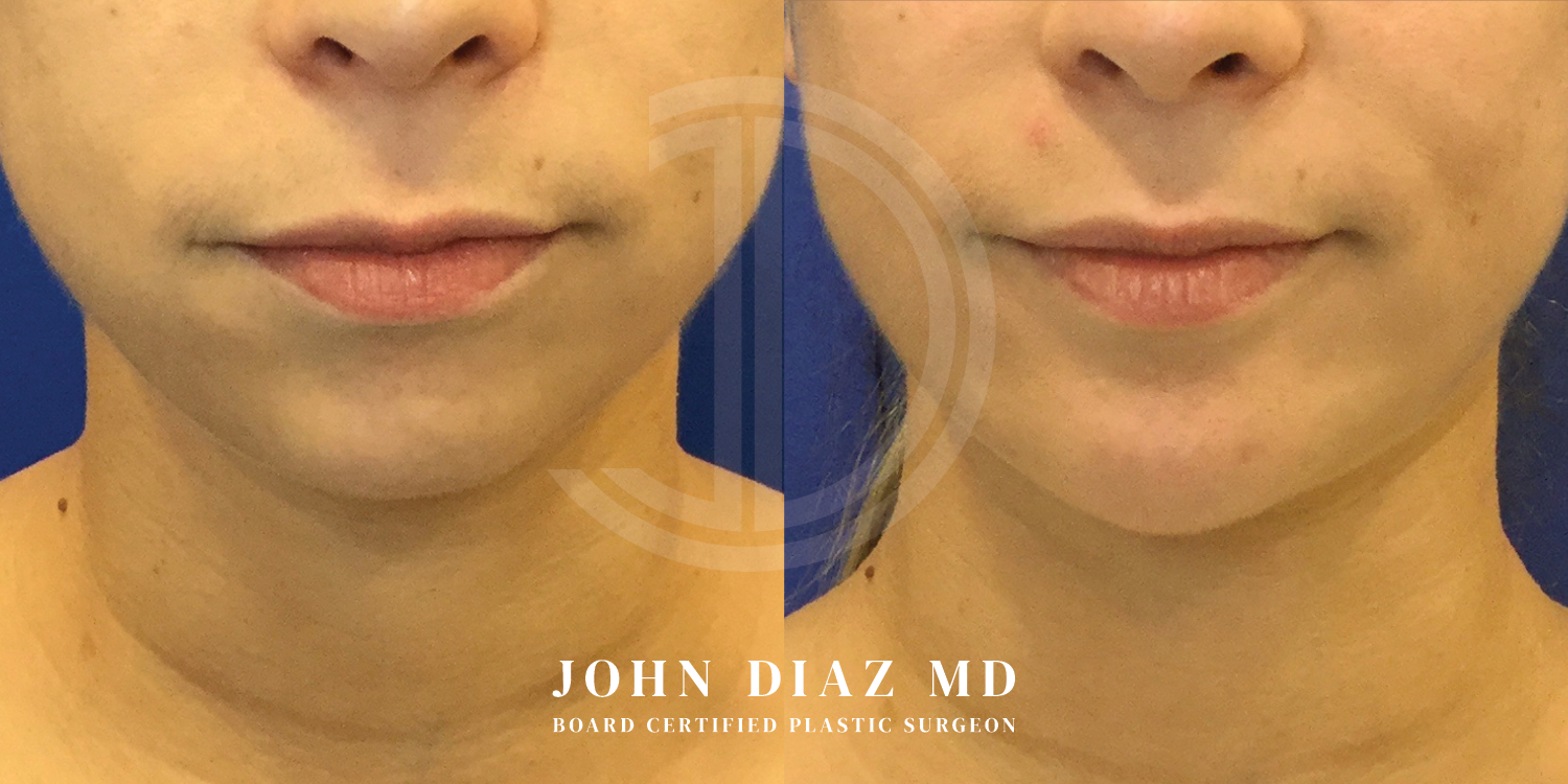 Dr John Diaz Chin Augmentation Before and After | Patient 10