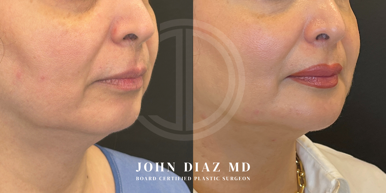Dr John Diaz Chin Augmentation Before and After | Patient 12