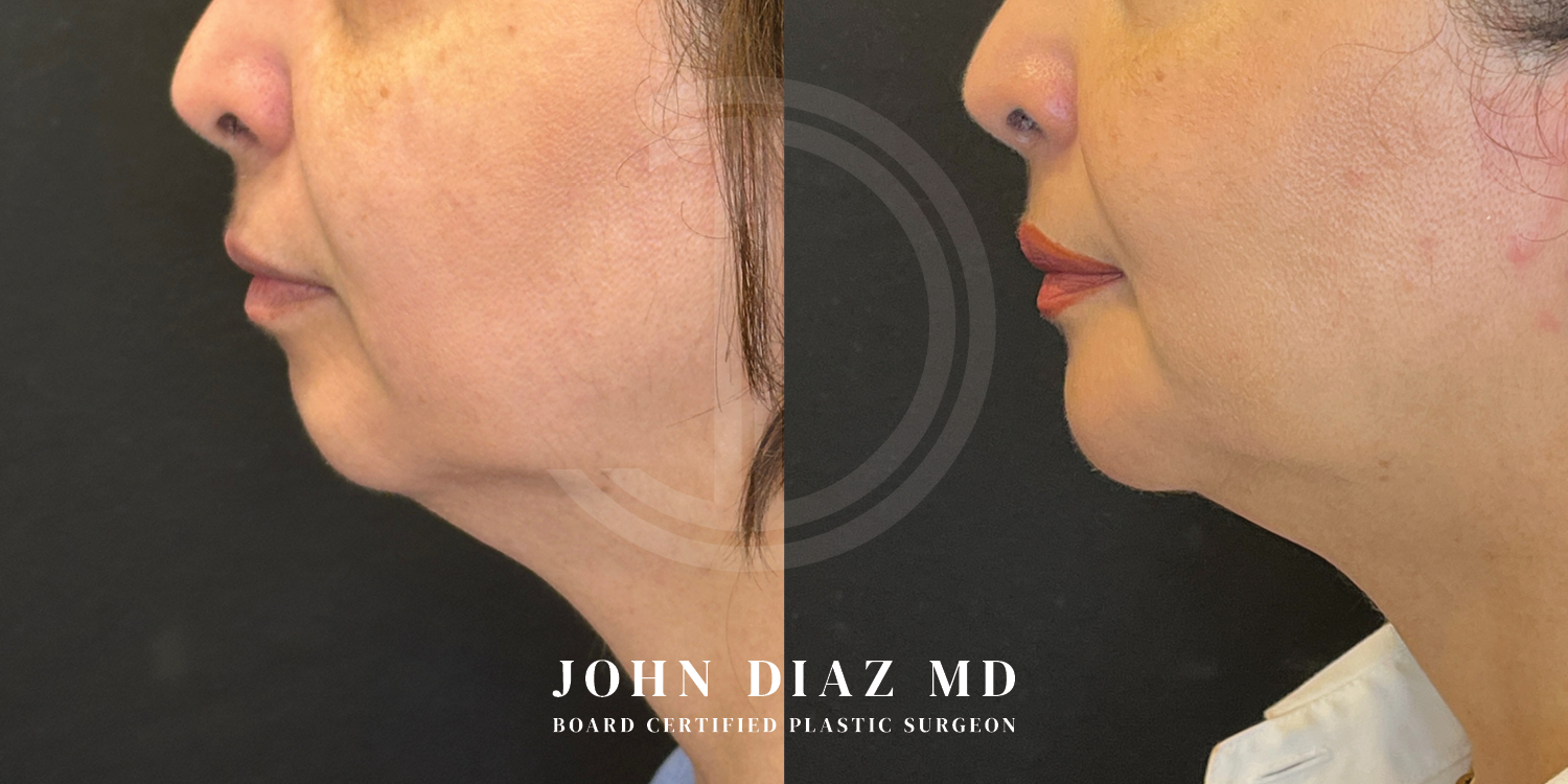 Dr John Diaz Chin Augmentation Before and After | Patient 12