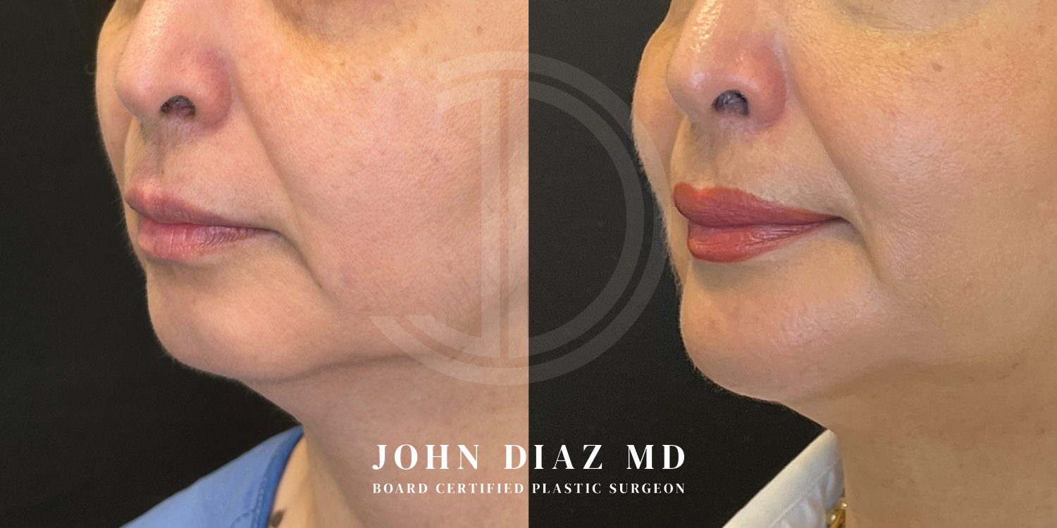 Dr John Diaz Chin Augmentation Before and After | Patient 12